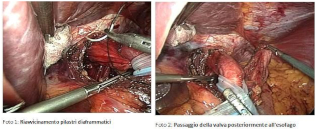 La Malattia da reflusso gastro-esofageo