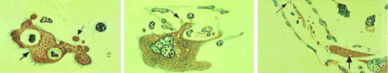 Porpora trombotica trombocitopenica