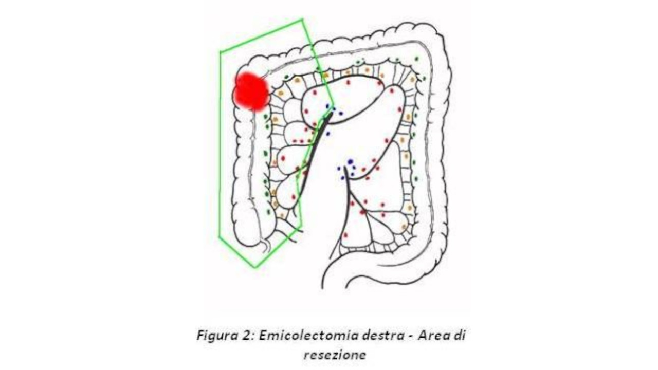 Emicolectomia destra totalmente laporoscopica per il trattamento dei tumori