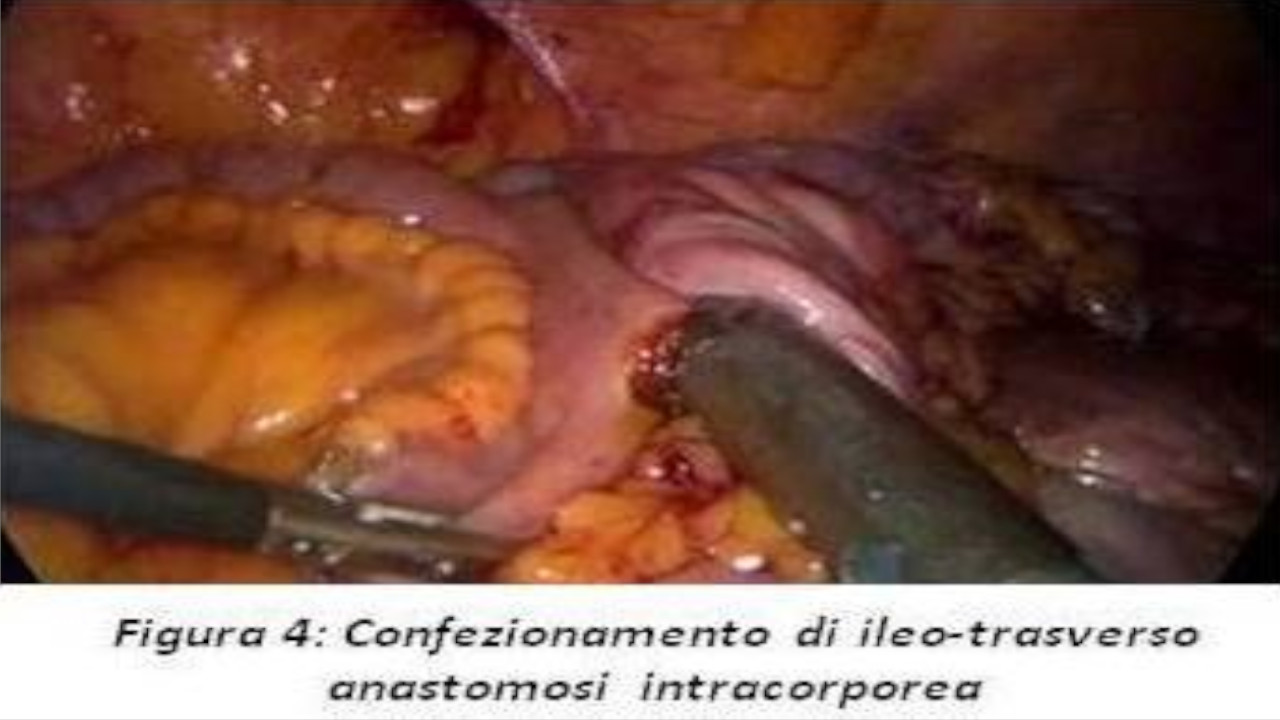 Emicolectomia destra totalmente laporoscopica per il trattamento dei tumori