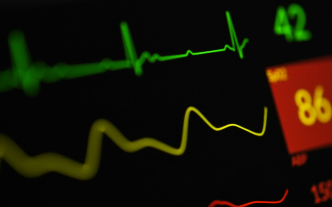 Fibrillazione atriale anche con gli anticoagulanti il rischio di declino cognitivo resta elevato
